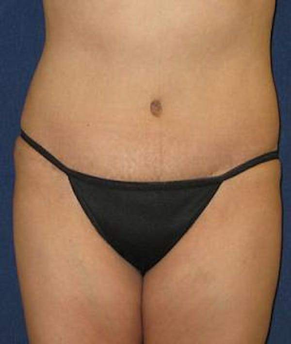 Tummy Tuck (Abdominoplasty) Gallery - Patient 4861888 - Image 2