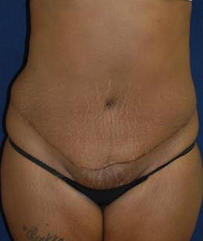 Tummy Tuck (Abdominoplasty) Gallery - Patient 4861895 - Image 2