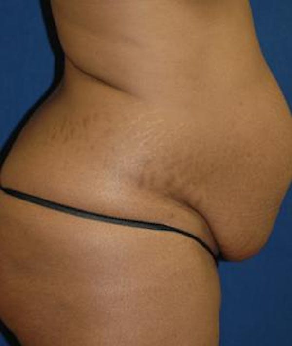 Tummy Tuck (Abdominoplasty) Gallery - Patient 4861895 - Image 3