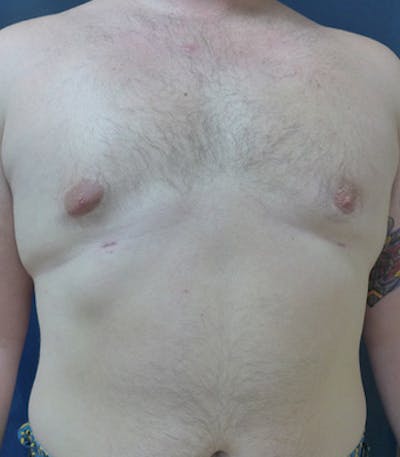 Male Subcutaneous Mastectomy (Gynecomastia) Gallery - Patient 4861896 - Image 2