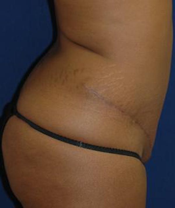 Tummy Tuck (Abdominoplasty) Gallery - Patient 4861895 - Image 4