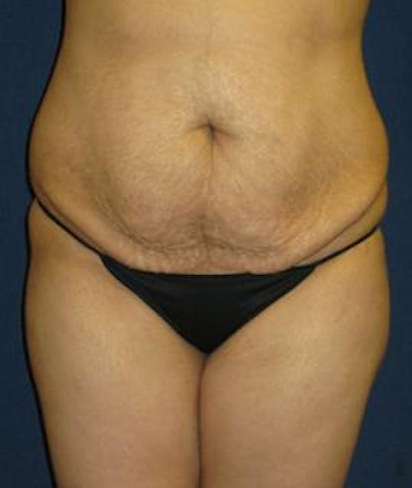 Tummy Tuck (Abdominoplasty) Gallery - Patient 4861897 - Image 1