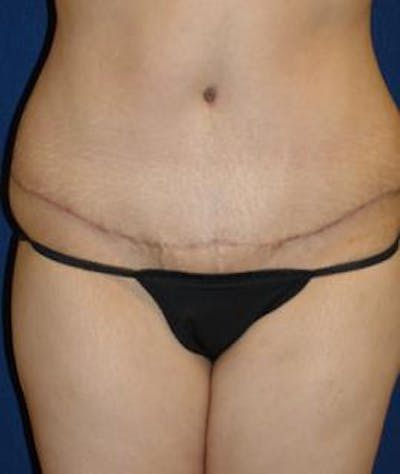 Tummy Tuck (Abdominoplasty) Gallery - Patient 4861897 - Image 2