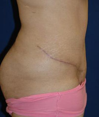 Tummy Tuck (Abdominoplasty) Gallery - Patient 4861897 - Image 4