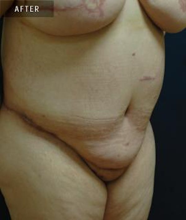 Tummy Tuck (Abdominoplasty) Gallery - Patient 4861899 - Image 2