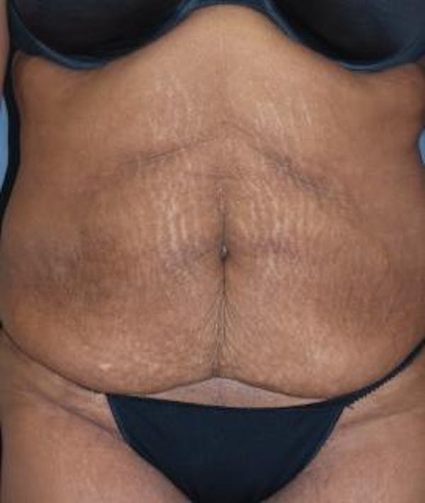 Tummy Tuck (Abdominoplasty) Gallery - Patient 4861901 - Image 3