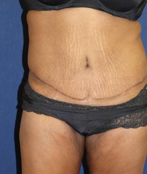 Tummy Tuck (Abdominoplasty) Gallery - Patient 4861901 - Image 4