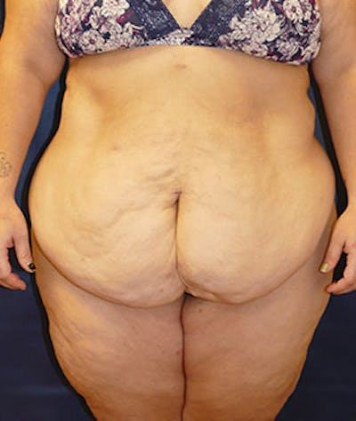 Tummy Tuck (Abdominoplasty) Gallery - Patient 4861906 - Image 1