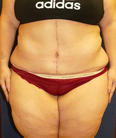 Tummy Tuck (Abdominoplasty) Gallery - Patient 4861906 - Image 2