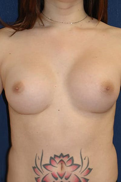Feminizing Surgery Gallery - Patient 4861907 - Image 2