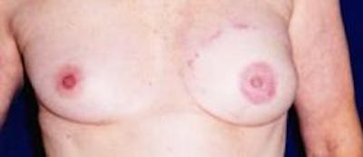 Breast Reconstruction Gallery - Patient 4861993 - Image 2