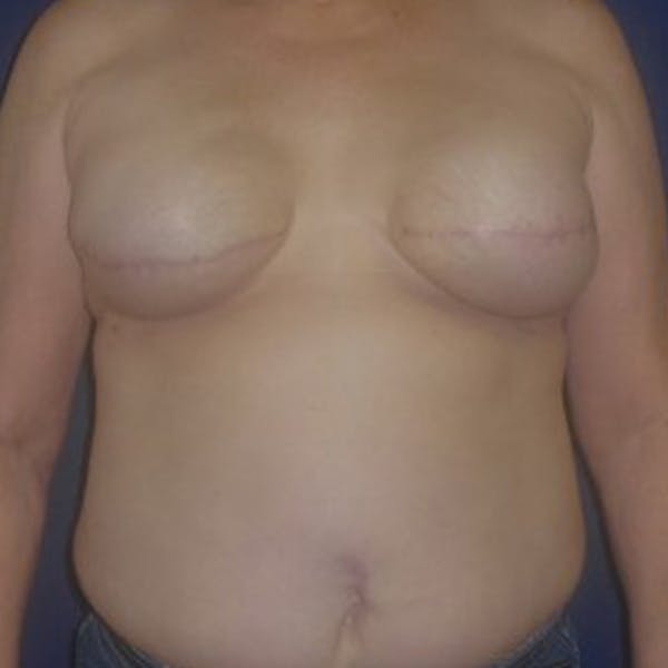 Before & After Houston Breast Reconstruction