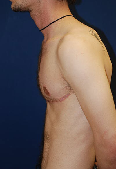 Masculinizing Surgery Gallery - Patient 4862069 - Image 4