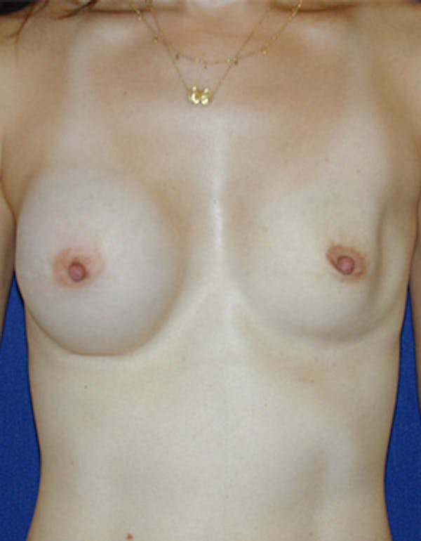 Breast Reconstruction Gallery - Patient 4861996 - Image 1