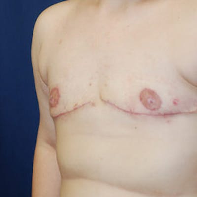 Masculinizing Surgery Gallery - Patient 4862078 - Image 2