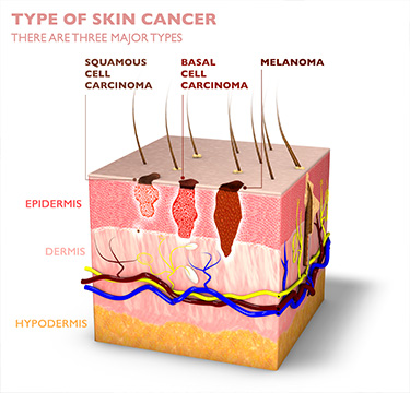 Types of skin cancer diagram