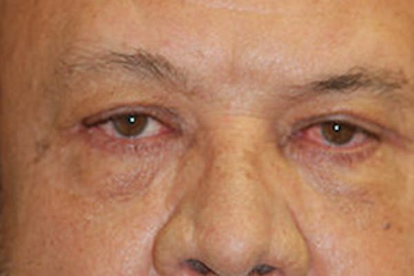 Eyelid Lift (Blepharoplasty) Gallery - Patient 4861535 - Image 2