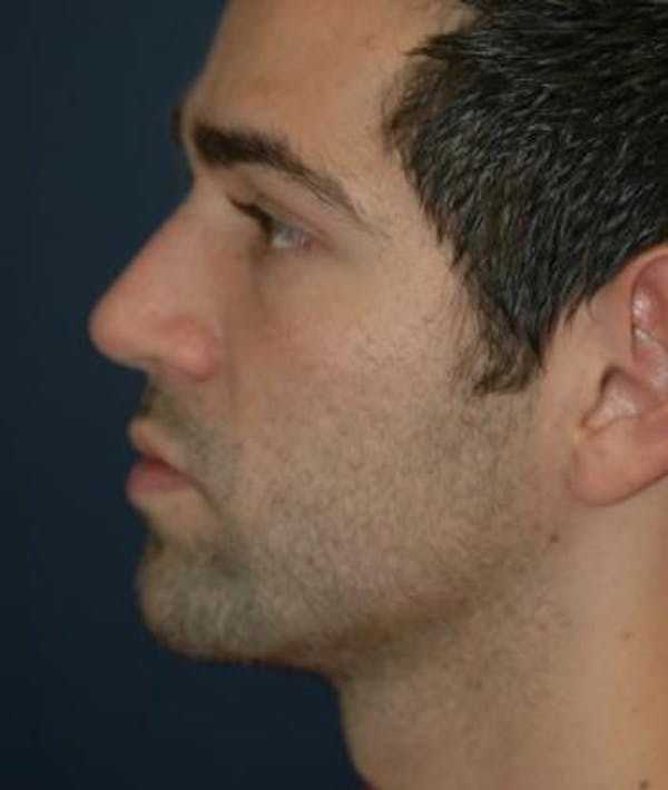 Houston Rhinoplasty Before and After