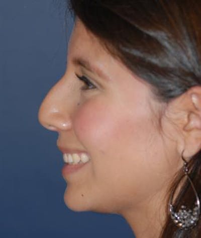 Rhinoplasty Gallery - Patient 4861544 - Image 1