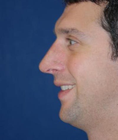 Rhinoplasty Gallery - Patient 4861557 - Image 4