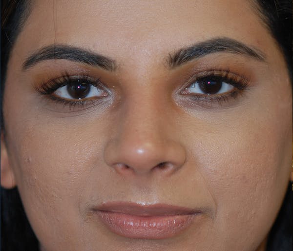 Rhinoplasty Gallery - Patient 11869692 - Image 2