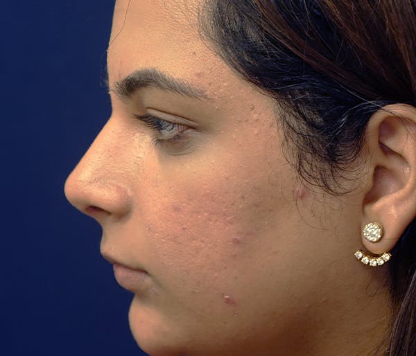 Rhinoplasty Gallery - Patient 11869692 - Image 3