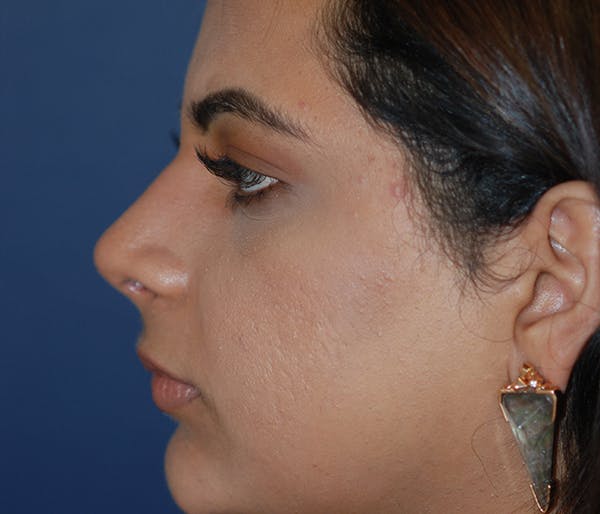 Rhinoplasty Gallery - Patient 11869692 - Image 4