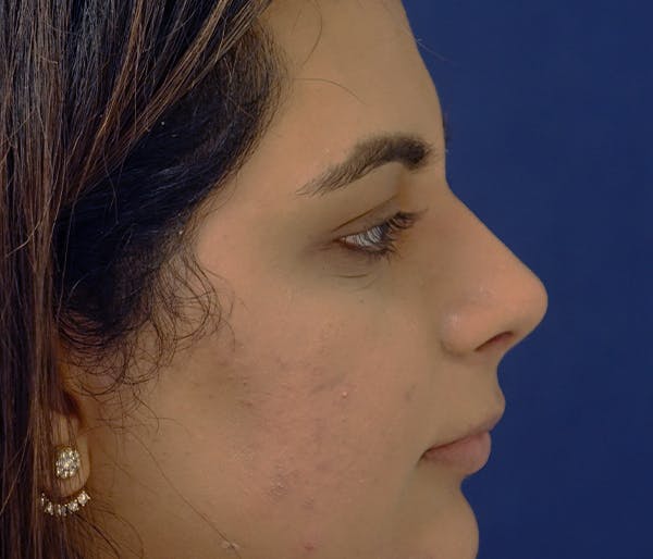 Rhinoplasty Gallery - Patient 11869692 - Image 5