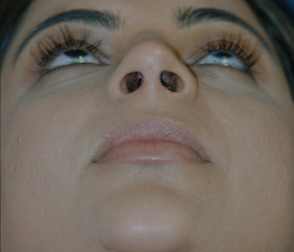 Rhinoplasty Gallery - Patient 11869692 - Image 8