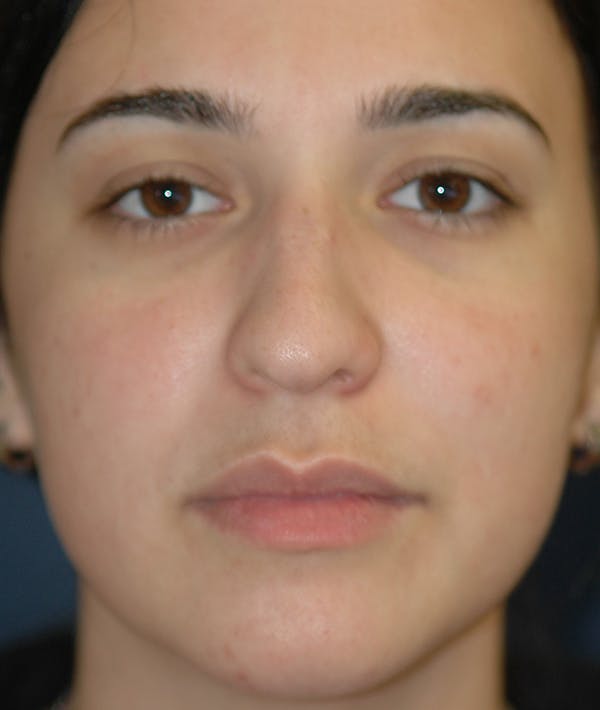 Rhinoplasty Gallery - Patient 14605622 - Image 1