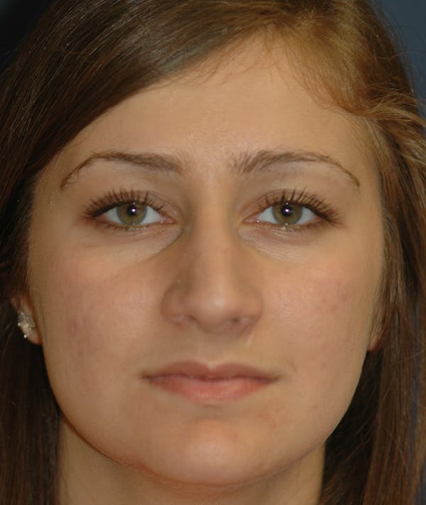 Rhinoplasty Gallery - Patient 14605623 - Image 2