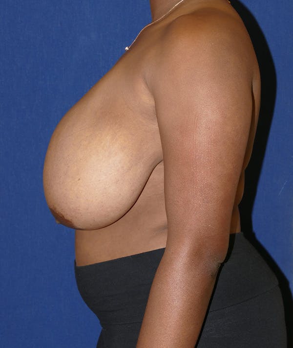 Breast Reduction Gallery - Patient 19493863 - Image 5