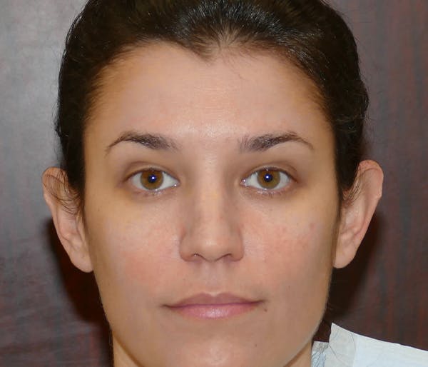 Ear Pinning (Otoplasty) Gallery - Patient 25995139 - Image 1