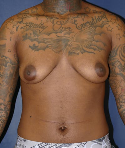 Masculinizing Surgery Gallery - Patient 31728850 - Image 1