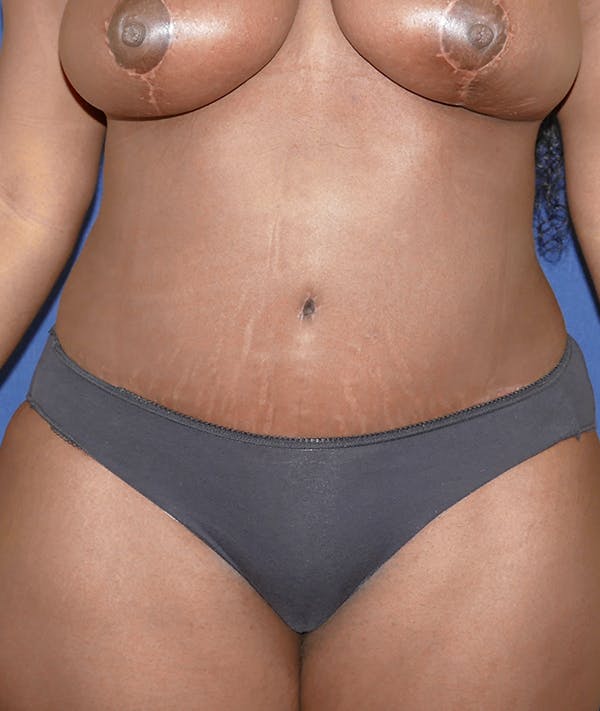 Tummy Tuck (Abdominoplasty) Gallery - Patient 31729553 - Image 2