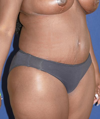 Tummy Tuck (Abdominoplasty) Gallery - Patient 31729553 - Image 8