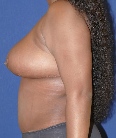 Breast Reduction Gallery - Patient 31729623 - Image 6