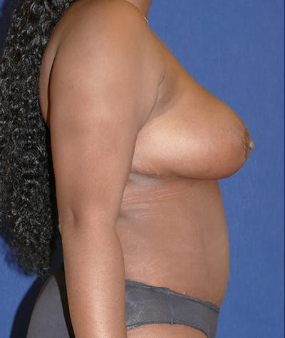 Breast Reduction Gallery - Patient 31729623 - Image 10