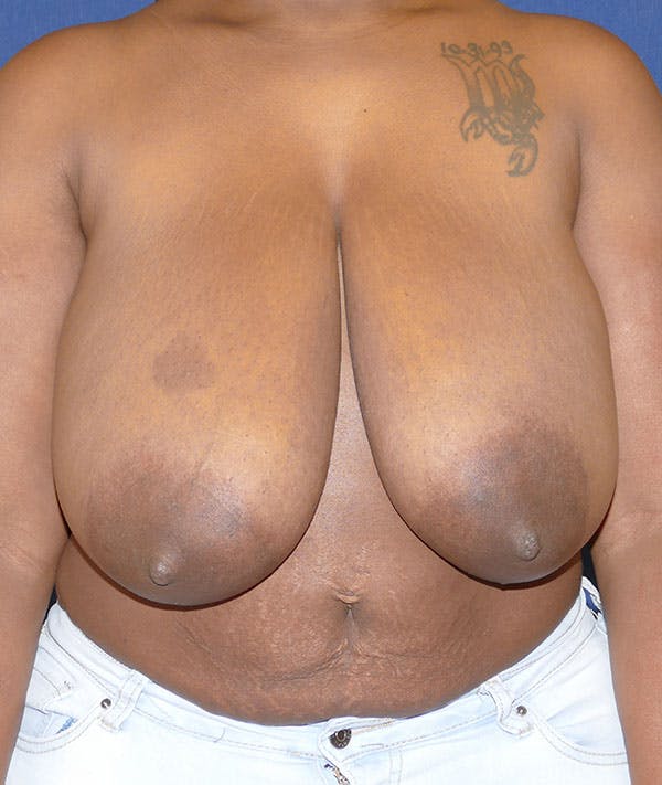 Breast Reduction Gallery - Patient 43640034 - Image 1
