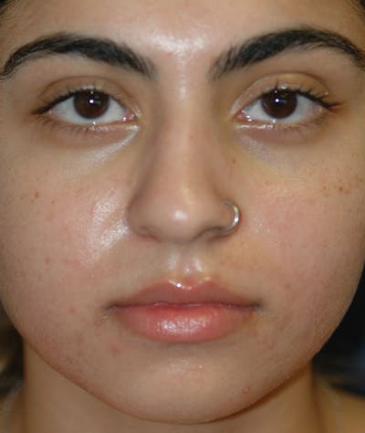 Rhinoplasty Gallery - Patient 43670753 - Image 1