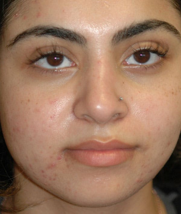 Rhinoplasty Gallery - Patient 43670753 - Image 2