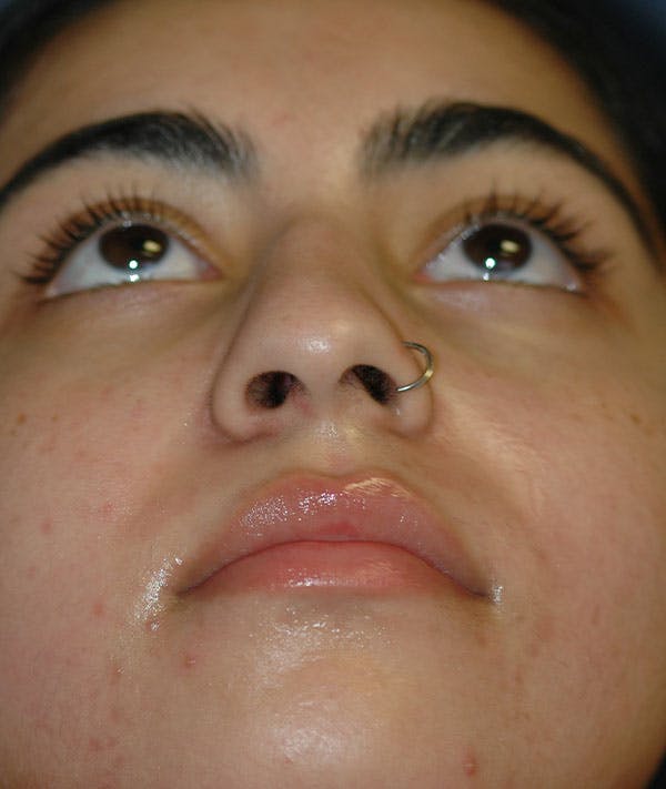 Rhinoplasty Gallery - Patient 43670753 - Image 3