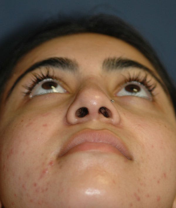 Rhinoplasty Gallery - Patient 43670753 - Image 4