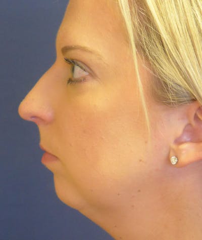 Rhinoplasty Gallery - Patient 43683021 - Image 1