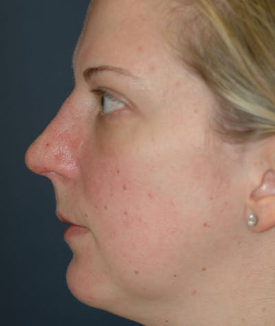 Rhinoplasty Gallery - Patient 43683021 - Image 2