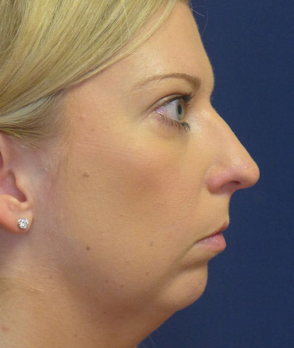 Rhinoplasty Gallery - Patient 43683021 - Image 3