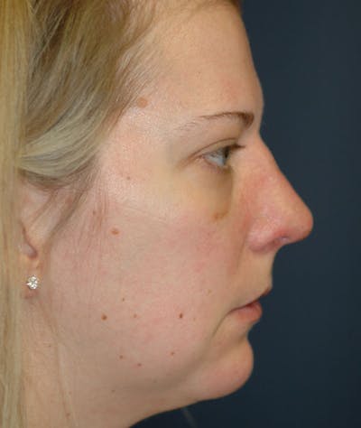 Rhinoplasty Gallery - Patient 43683021 - Image 4