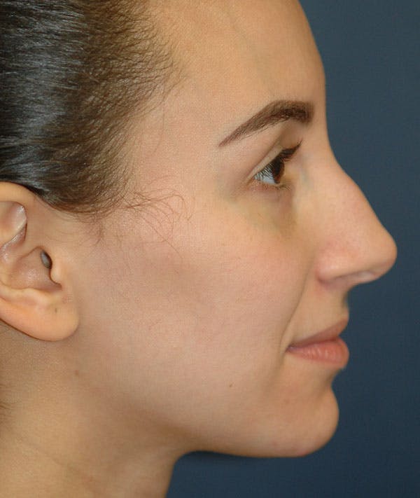 Rhinoplasty Gallery - Patient 43695340 - Image 5