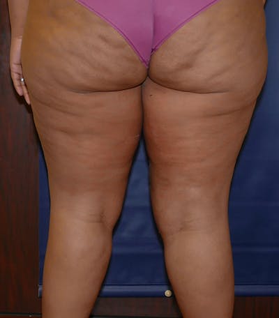 Thigh Lift Gallery - Patient 54026074 - Image 2