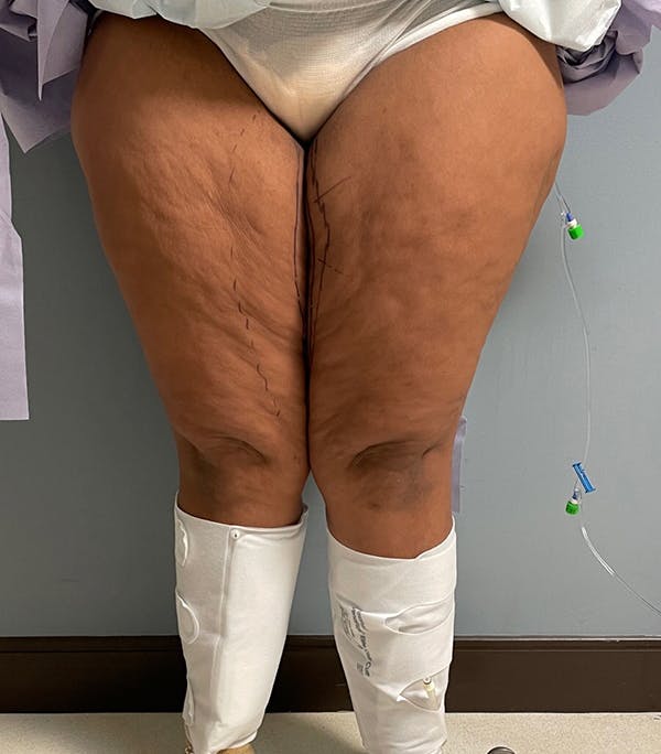 Thigh Lift Gallery - Patient 54026074 - Image 3